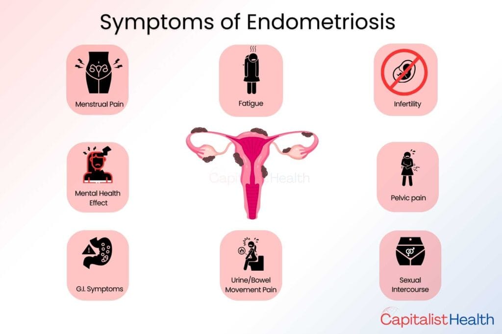 Capitalist Health - Symptoms of Endometriosis - Endometriosis Symptoms and Treatment Options