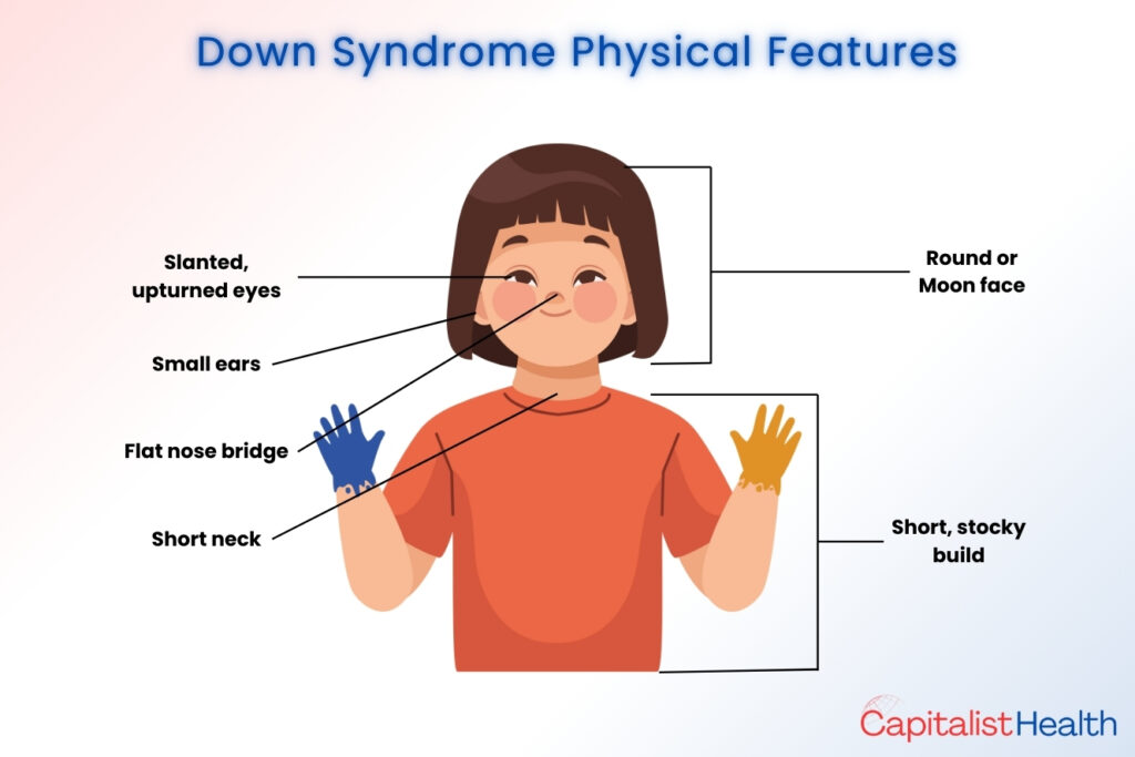 What is Down Syndrome - Common Misconceptions
