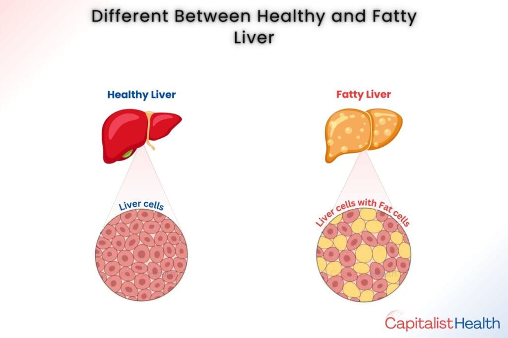 Fatty Liver Reversal – Diet, Exercise, and Symptoms –Capitalist Health - What is Fatty Liver